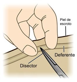 planificacion familiar vasectom&iacute;a galicia coru&ntilde;a