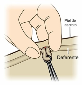 vasectomia sin dolor urologo coru&ntilde;a