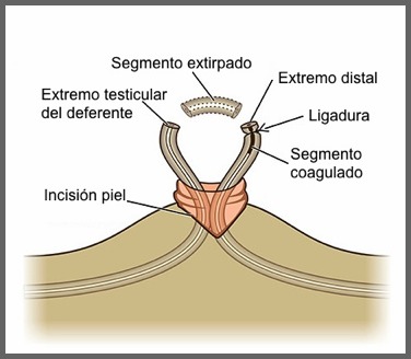 vasectomia sin bisturi coru&ntilde;a lugo ferrol