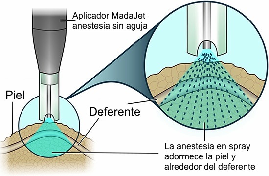 vasectomia sin aguja coru&ntilde;a