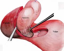 adenoma